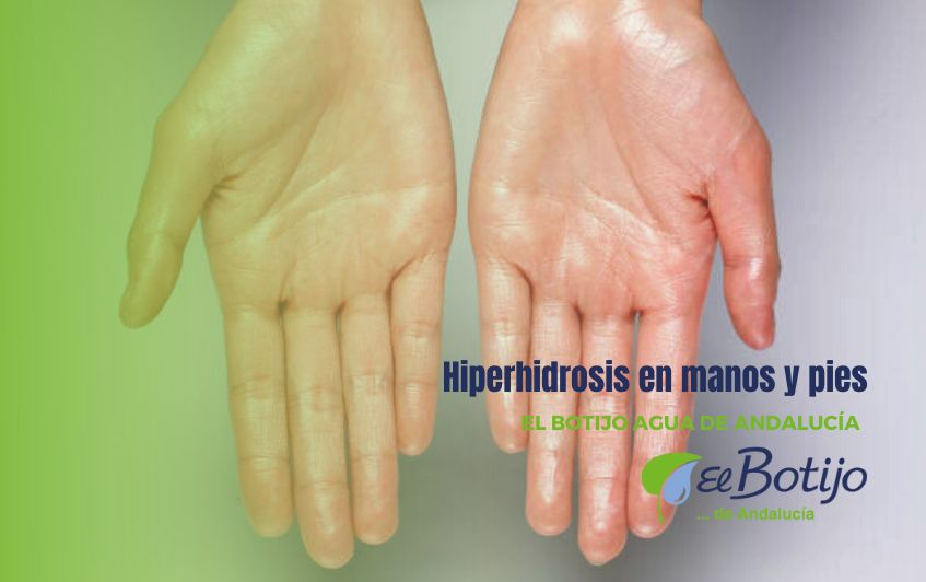hiperhidrosis en manos y pies
